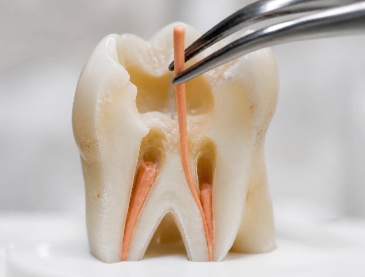 Cross-section of a molar with gutta percha being placed into the root canals