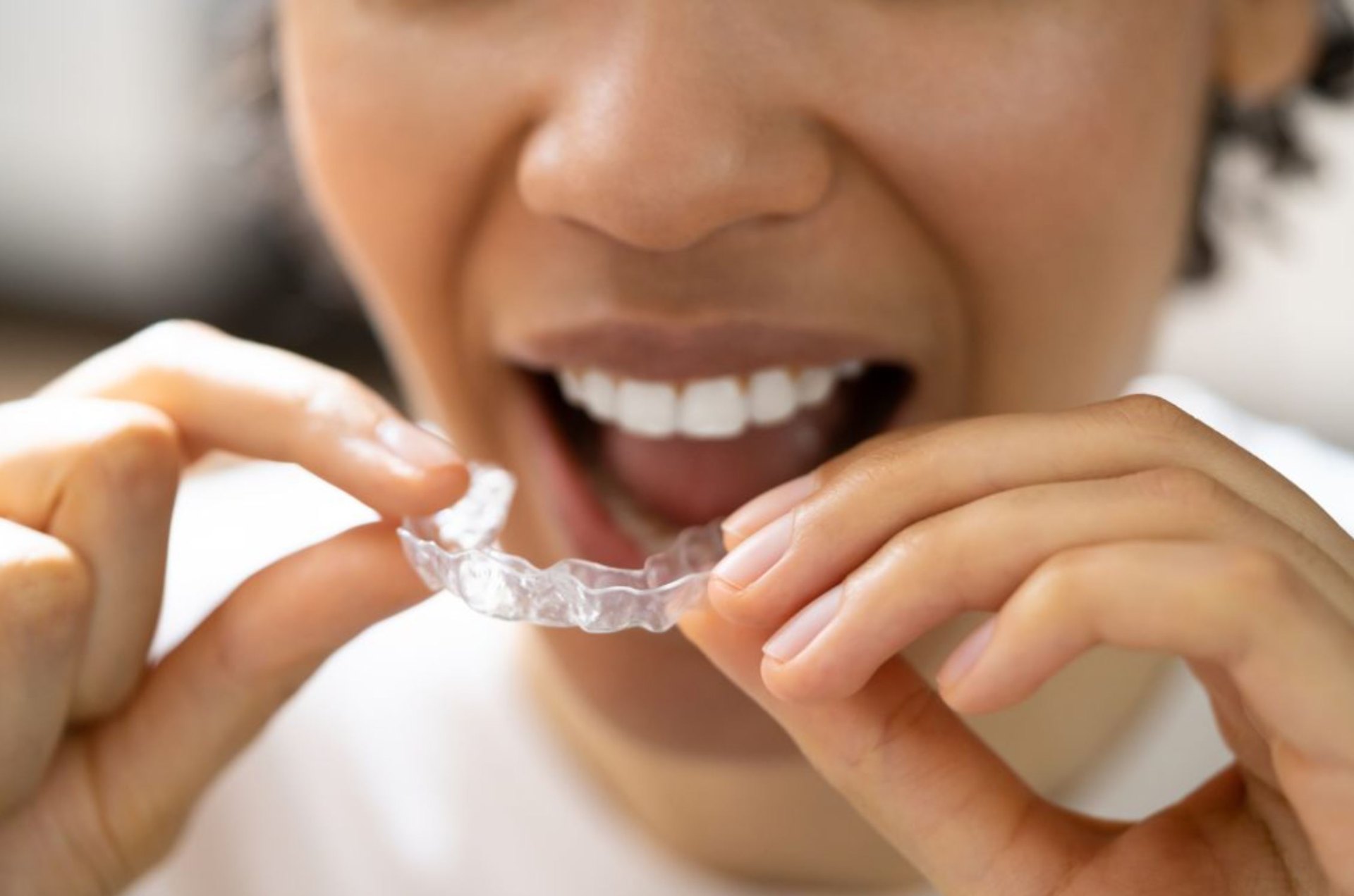Patient receiving customized clear aligner treatment